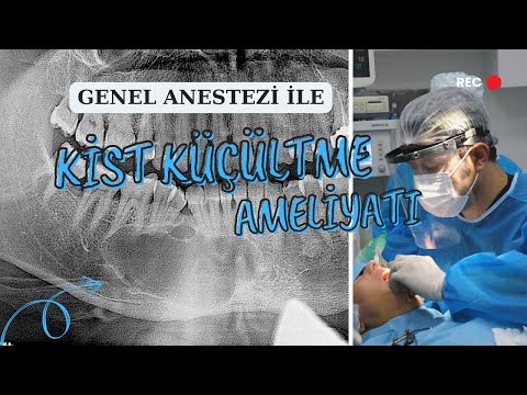 GENEL ANESTEZİ İLE DİŞ KİSTİ KÜÇÜLTME AMELİYATI | PROF. DR. MUSTAFA TEK