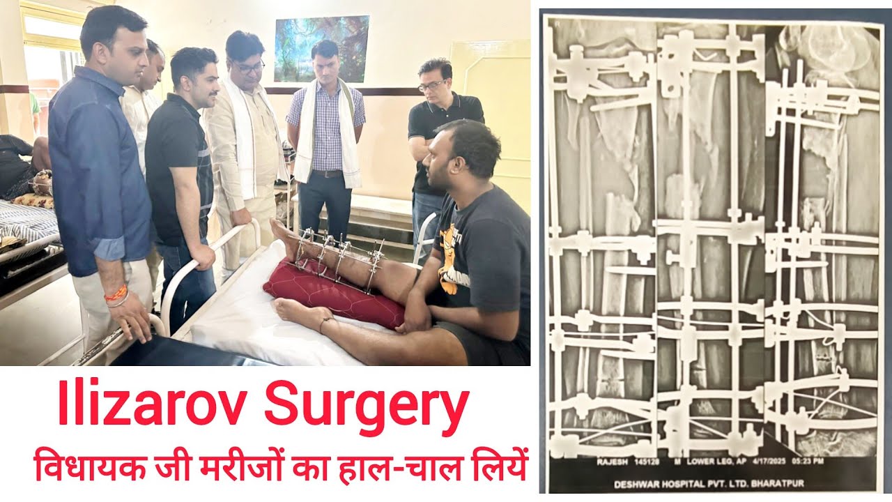 Ilizarov Surgery in Infection and non-union bones fracture विधायक जी मरीजों से मिलें