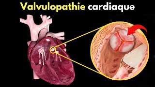 How Does Heart Valve Disease Occur? Symptoms, Diagnosis, And Treatment