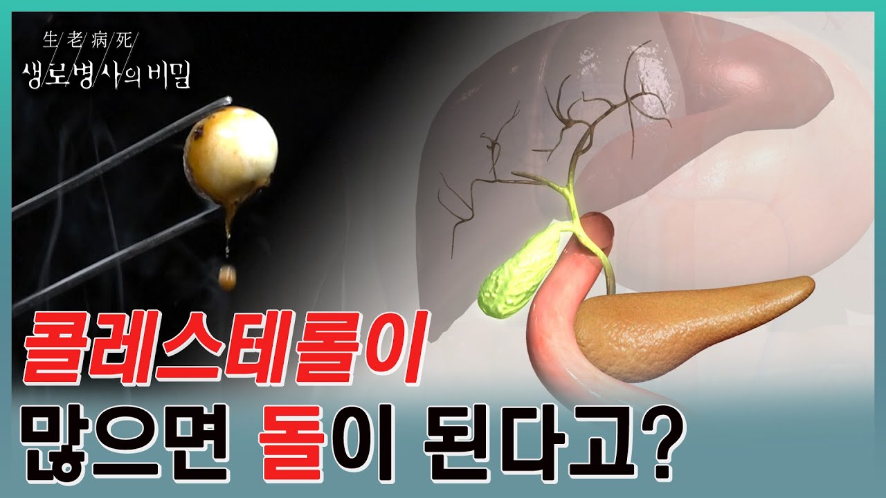 “아이를 낳는 산고처럼 극심한 통증이 온 거죠”라며 복통을 호소하고, 방치하면 담도를 막아 담도암까지 이르게 하는 치명적인 담석 ...
