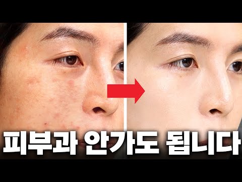 여드름쟁이 내가 피부가 좋아진 이유