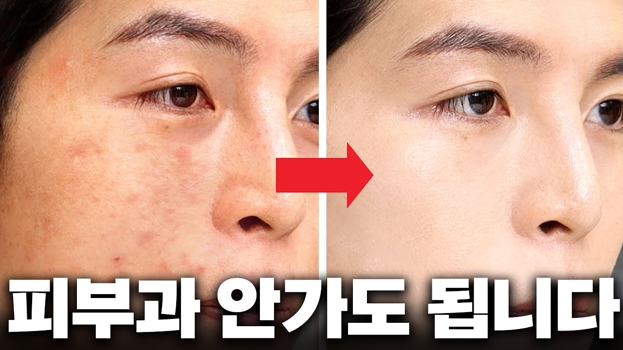 여드름쟁이 내가 피부가 좋아진 이유