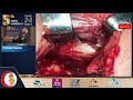 Session 4.2 DDH Surgical technique of anterior open reduction - Khaled Al-Adwar 2/3/2023