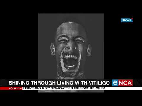 Living with vitiligo