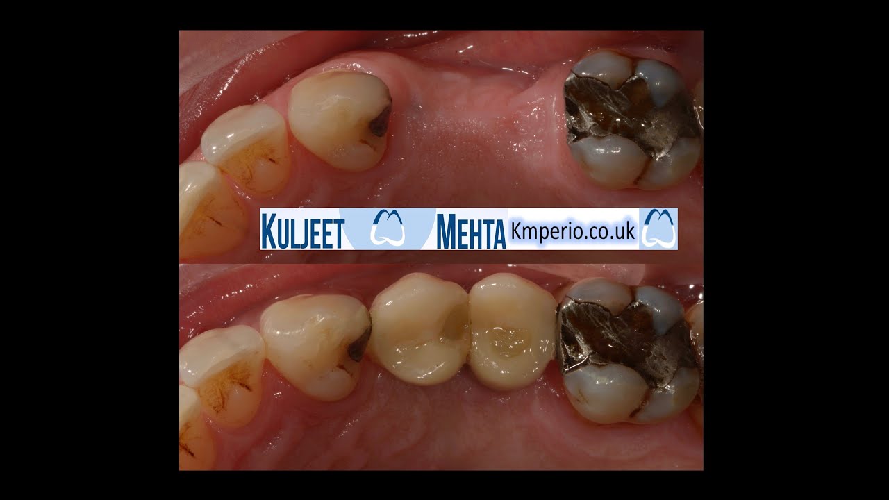 Dental Implants Screw Retained Crowns . YouTube
