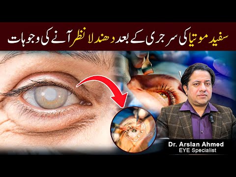 Blurry Vision After Cataract Surgery? Causes & Solutions Explained Urdu/Hindi