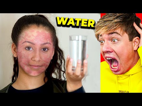 Video: De Toestand Van Het Meisje Dat Allergisch Is Voor Water, Verslechtert