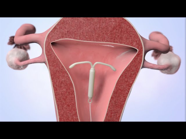 Mirena for Endometriosis caused heavy bleeding, does that work? – Dr. Deepa  Ganesh