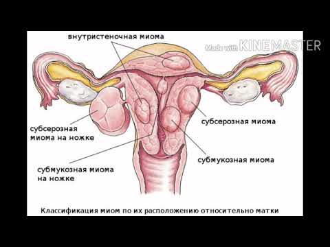 Миома эмне себептен пайда болот жана аны кантип дарыласа болот?