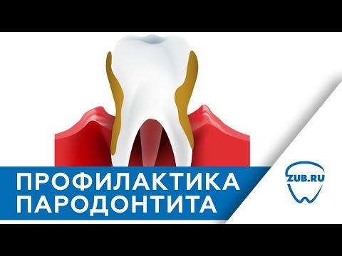 Видео: ❶ Зъболечение: профилактика на пародонтит