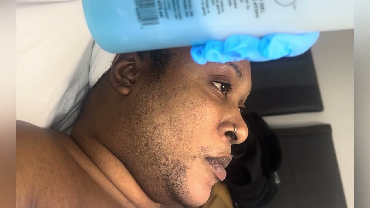 Вросшие волосы на лице после восковой депиляции с использованием твердого воска в салоне Shreembe...