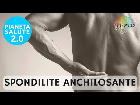 Video: Comprensione Della Progressione Della Spondilite Anchilosante