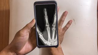 How to take a X-ray using your phone