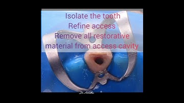 How to do intracoronal/non vital/walking bleach in discolored tooth??? #dentist #bleach #dentistry