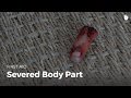 Learn first aid gestures severed body part