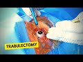 Trabulectomy