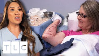 Dr Lee Sets A New Record By Removing 68 Lipomas From This Womans Arms Dr Pimple Popper Pop Ups