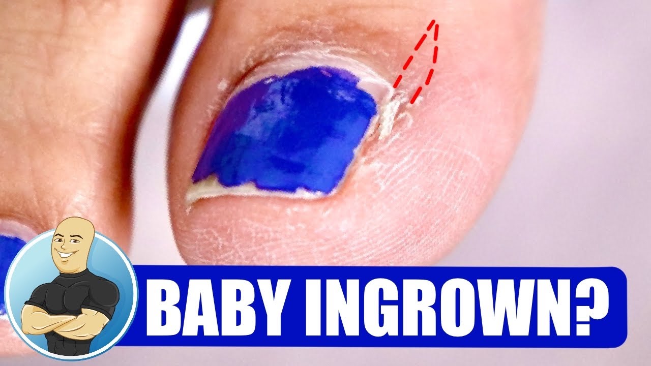 Ingrown toenail | BabyCenter