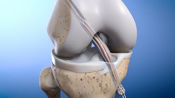 Tendon Repair | MOA Animation