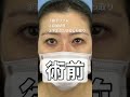 40代女性、整形感ゼロの目元若返り。
