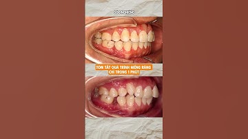 Kết Quả Niềng Răng Lệch Lạc, Khấp Khểnh Như Thế Nào? |Niềng răng Nha khoa Vân Anh #shorts