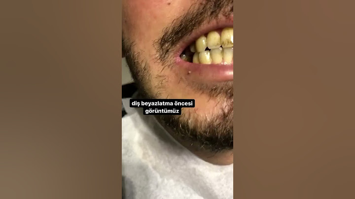 polisaj+ofis tipi diş beyazlatma uygulaması öncesi ve sonrası (detertraj hariç)