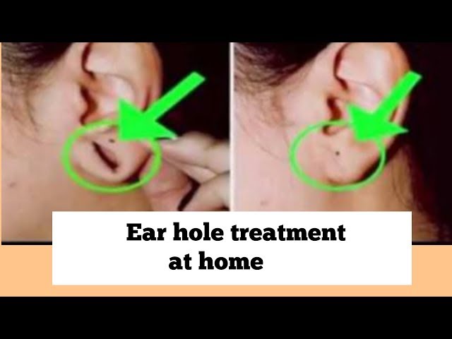 Ear hole treatment at home कानों के छिद्र छोटे