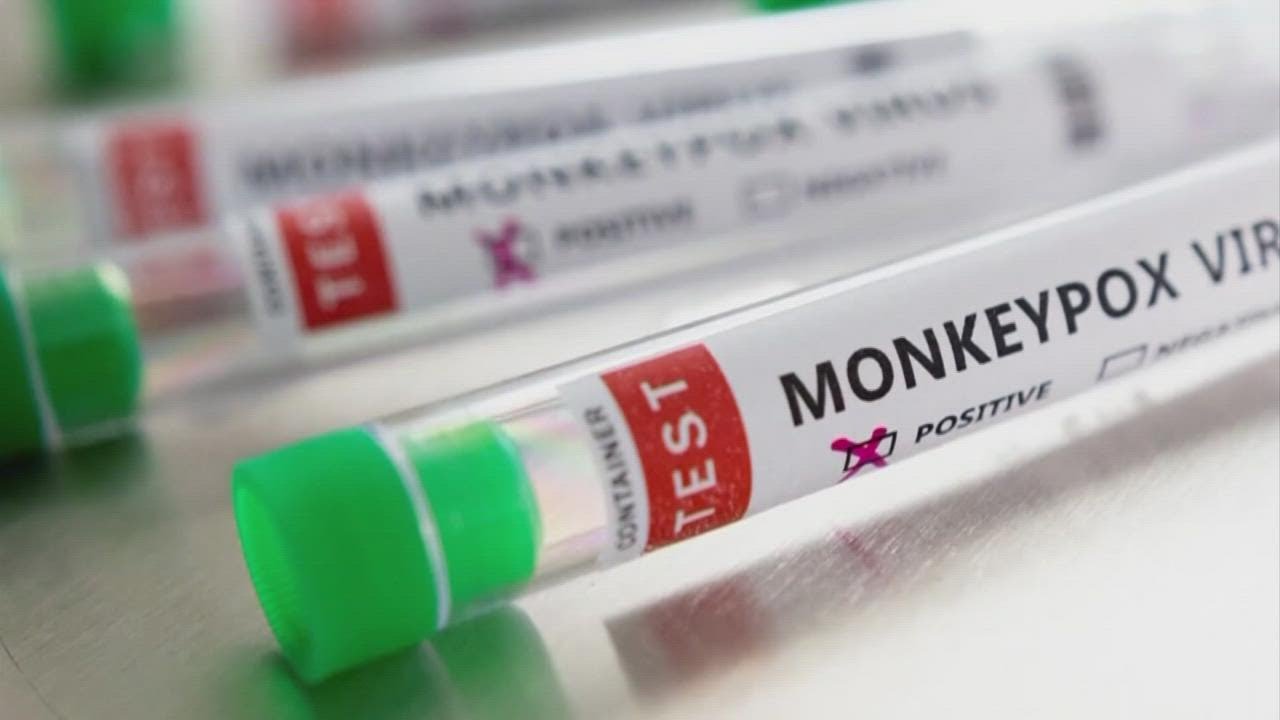 Man in Columbus area diagnosed with monkeypox