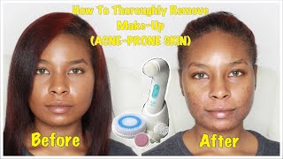 How To Thoroughly Remove Makeup | Acne-Prone Skin | Sekoya Hicks