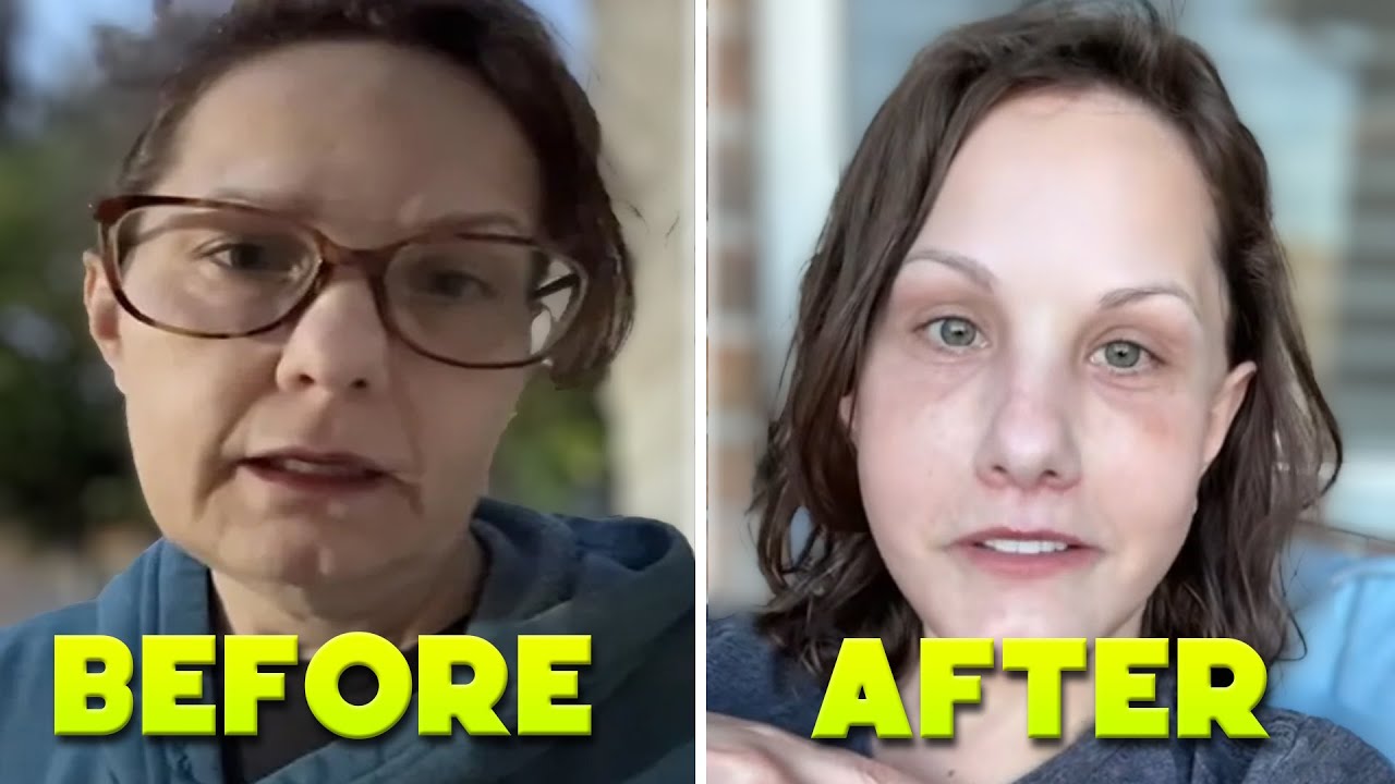 Michelle Wood Facelift - Full Plastic Surgery Transformation (Before & After)