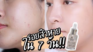 รอยสิวจงหมดไป!! รีวิว Kiehl’s Dark Spot Serum ตัวดัง พิสูจน์ 7 วัน รอยสิวหายจริงไหม!?? | Soundtiss