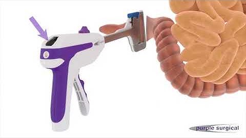 The Ultimate Reloadable Linear Stapler with Indicator on Vimeo1