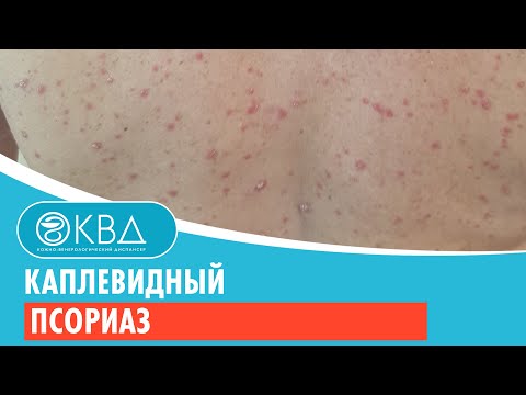 😐 Каплевидный псориаз. Клинический случай №213