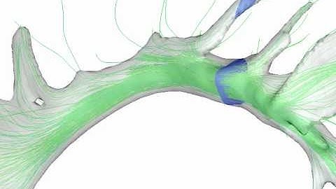 OpenWalnut: Visualizing DTI Parameters on Boundary Surfaces of White Matter Fiber Bundles