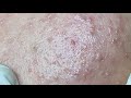 How to get rid of blackheads in oily skin hoangmyspa99