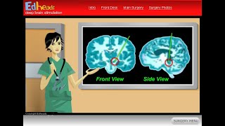 Edheads Deep Brain Stimulation Game Play