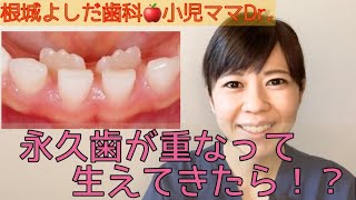 小児ママDr.『永久歯が重なって生えてきた！？』