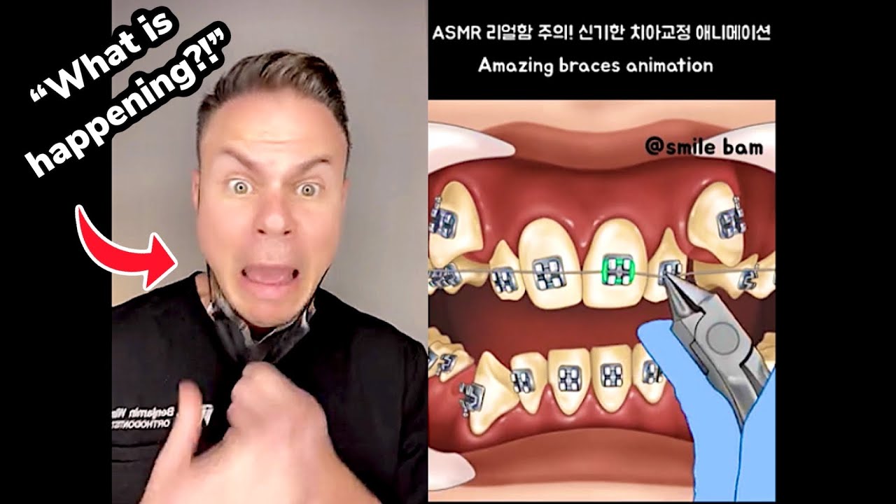 Amazing Korean Braces Transformation. Orthodontist Reacts! YouTube