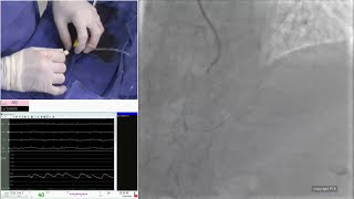 Complex PCI in ACS patient with high bleeding risk: optimise the strategy - EuroPCR 2024