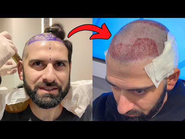 I Got A Hair Transplant In Turkey | My Full Experience - YouTube