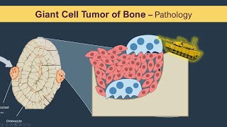 Giant cell tumor of Bone (Osteoclastoma) - Pathology