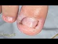 SINDACTILIA/POLIDACTILIA E PROCESSO INFLAMATÓRIO EM UM GAROTINHO #satisfying #nails #usa