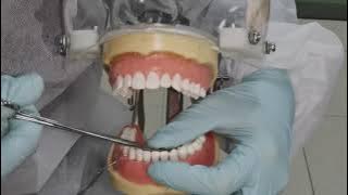 Prosedur splinting periodontal metode essig wire gigi 33 43  DGM Siti Nur Azizah 1910027004