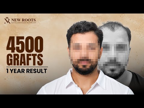 This 4500-Graft Transformation Is AMAZING 😮 | Hair Transplant Cost and Results in Mumbai | New Roots
