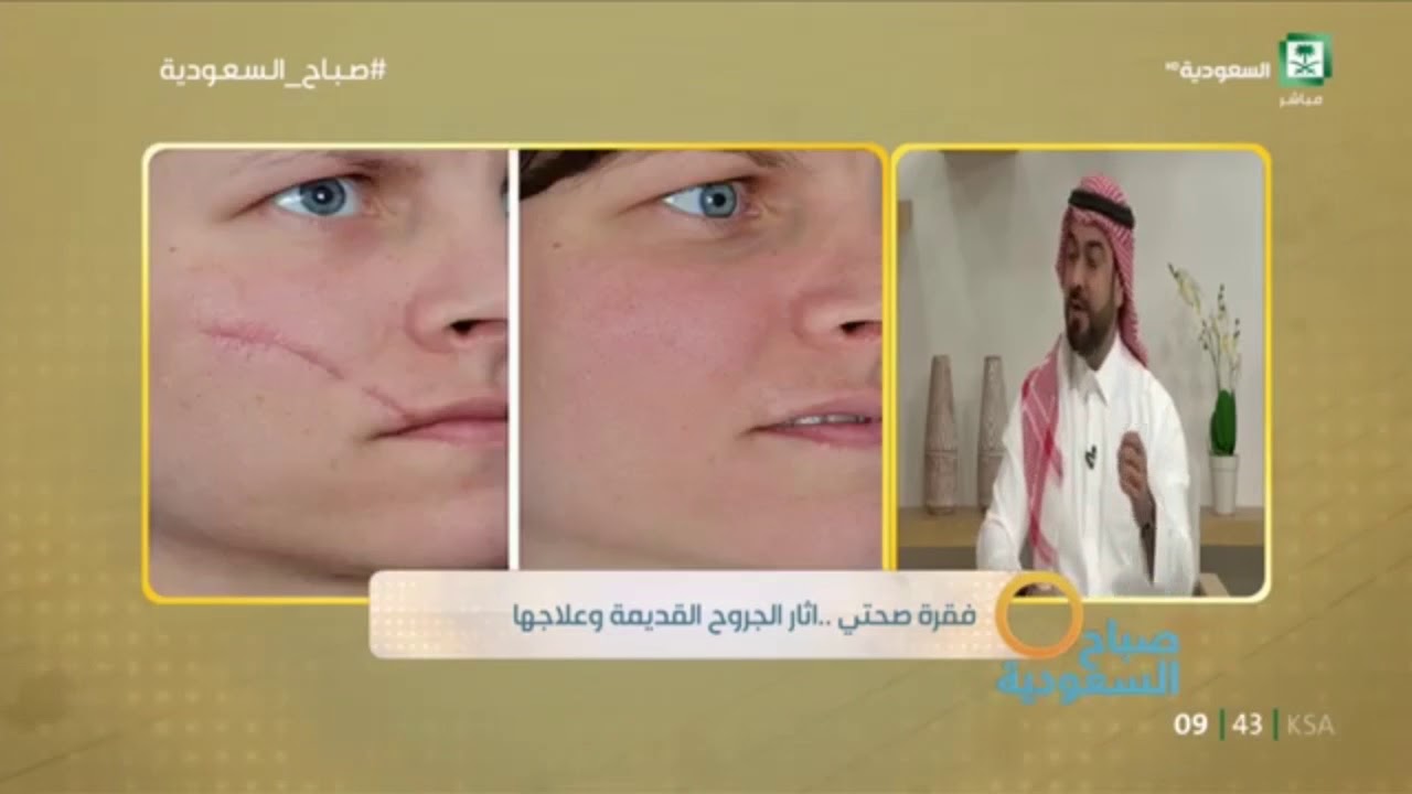 آثار الجروح القديمة وعلاجها