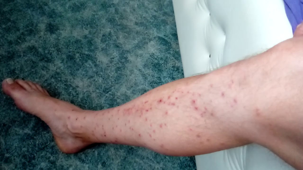 Осторожно- ЦЕРКАРИИ! - YouTube