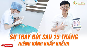 Niềng răng khấp khểnh, khớp cắn sâu - Phân tích sự thay đổi