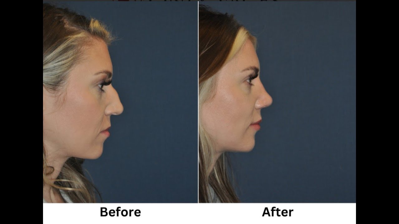 Rhinoplastybefore and after with Charlotte's top nose job surgeon, Dr. Sean Freeman YouTube