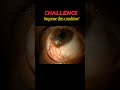 Diagnose the condition? Eye diseases diagnosis | #mbbs #ophthalmology #optometry #shorts #shortsfeed