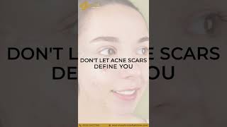 Acne ScArs Treatment #skincare #expertdermatologist #antiaging #acnetreatment #laserclinic